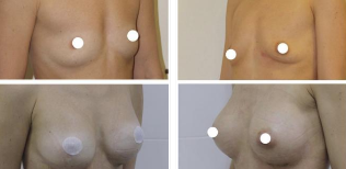 the breast augmentation