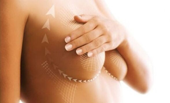 suture lift for breast augmentation