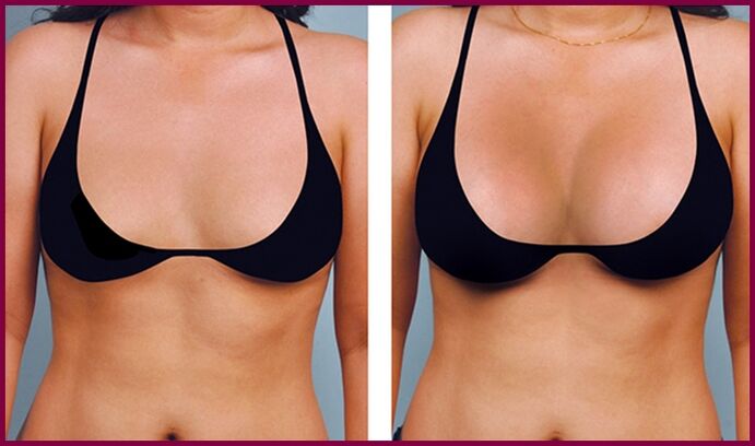 before and after fat breast augmentation
