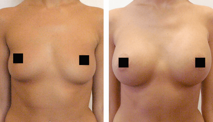 breasts before and after hyaluronic acid augmentation