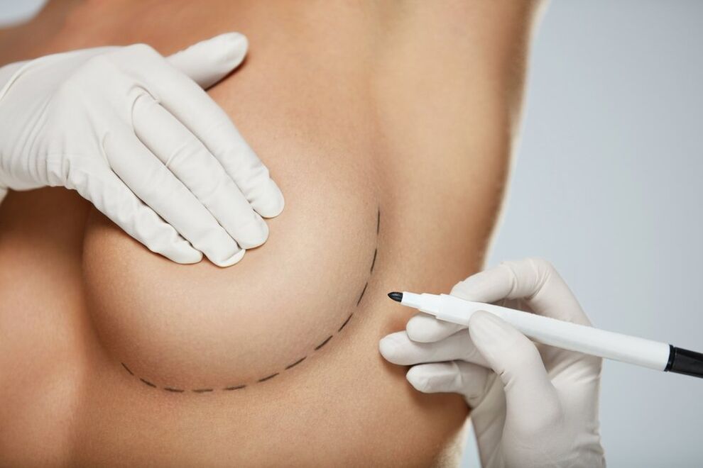 periareolar mammoplasty of the breast