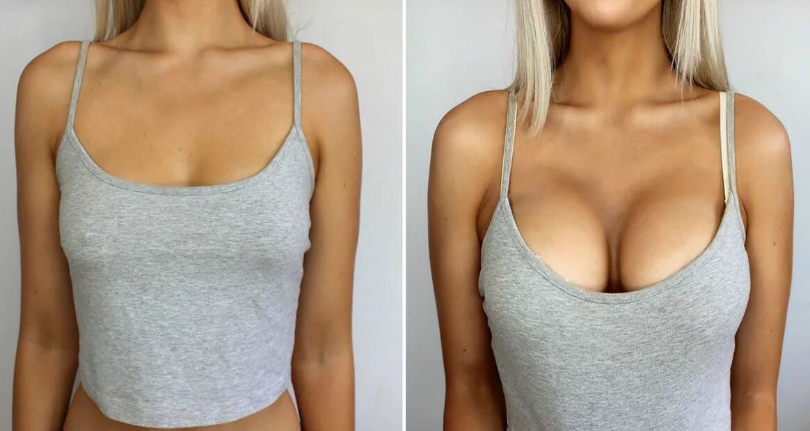 Breast increase 3 size