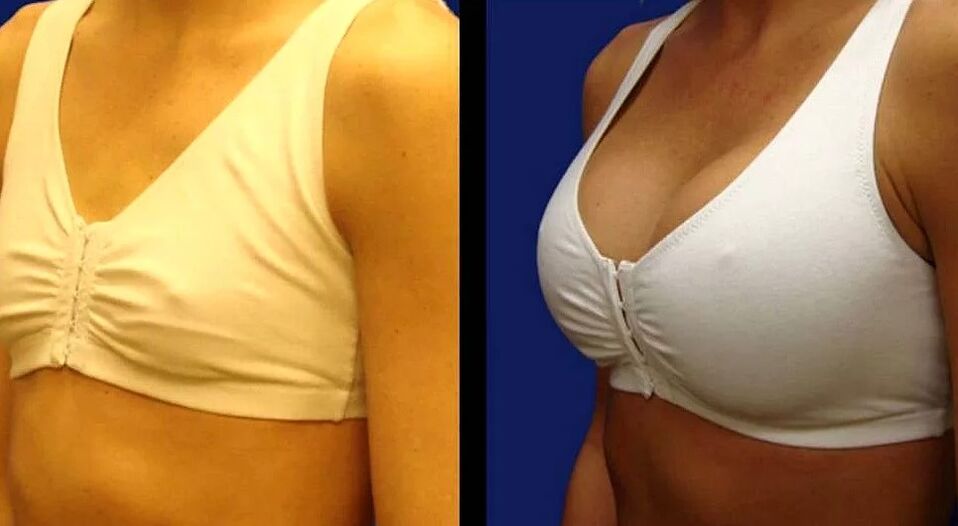 PHOTO OF BREAST BEFORE AND AFTER SURGERY