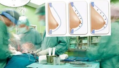 How sine lipilifting is performed
