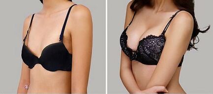 Photo before and after breast increase