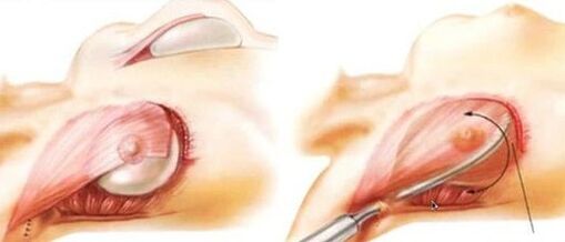 How the breast augmentation operation is performed