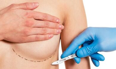 Submammatric access to breast enlargement with implants