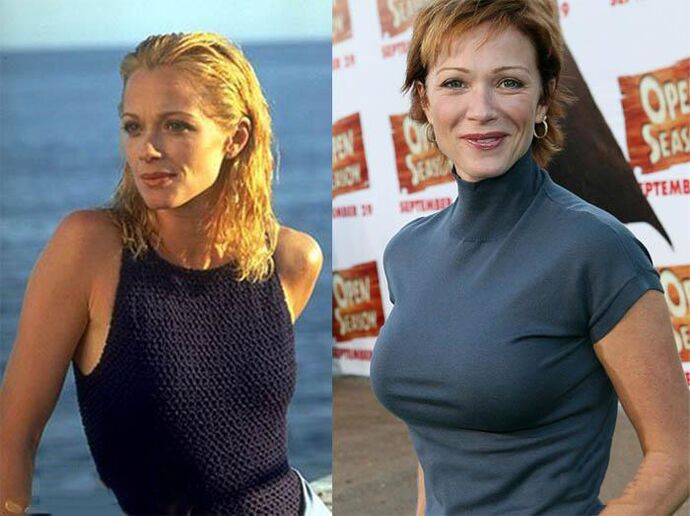 before and after mamublasty