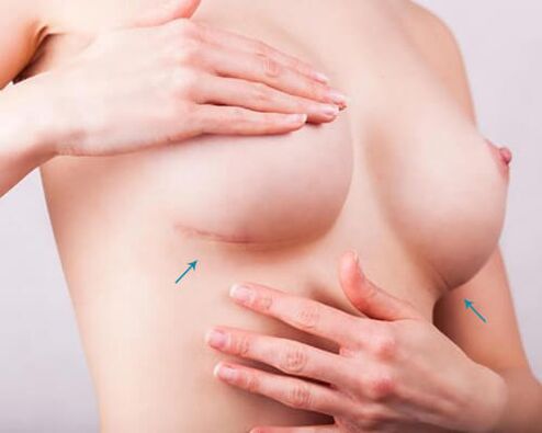 Breast expansion with implants