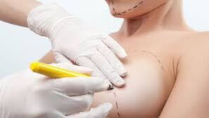 breast increase surgery
