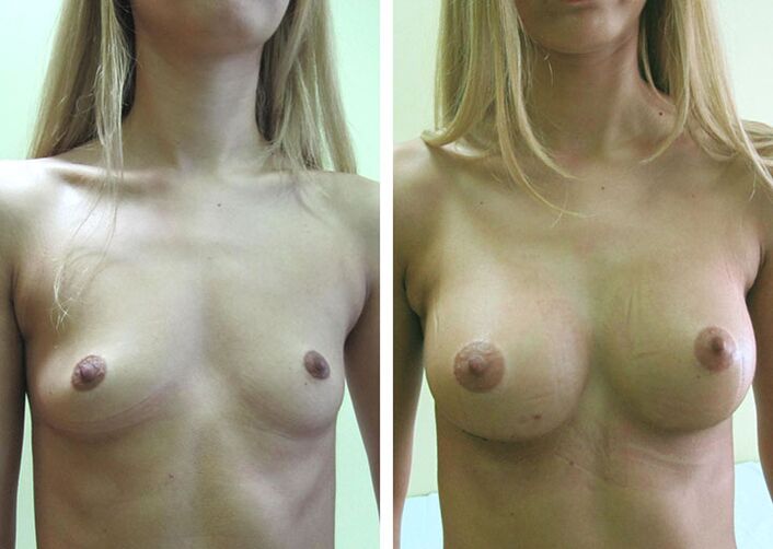 Breasts before and after breast augmentation