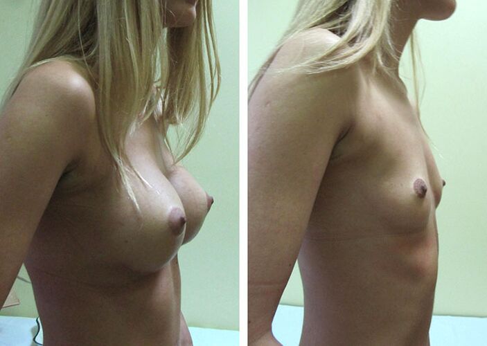 The result of breast augmentation with implants.