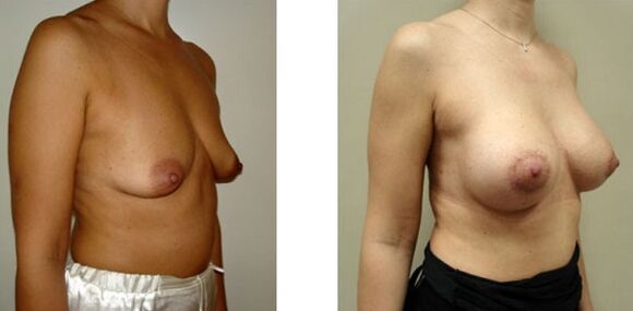 breast augmentation before and after