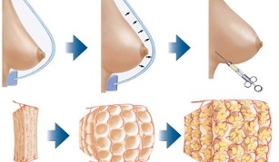 How is the fat breast augmentation procedure performed