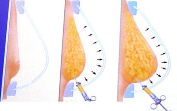 breast enlargement with fat
