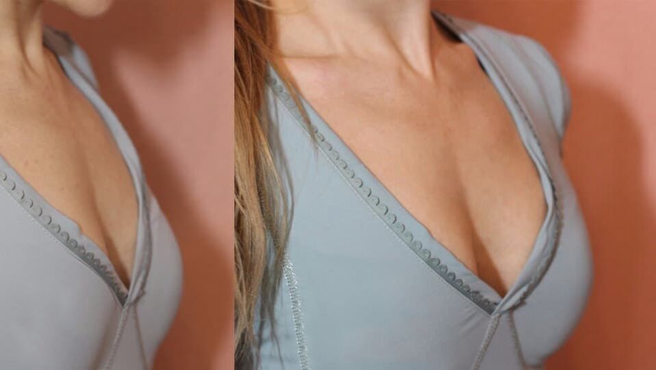 Breast enlargement products before and after.