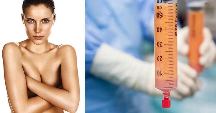 lipofilling as a method of breast augmentation